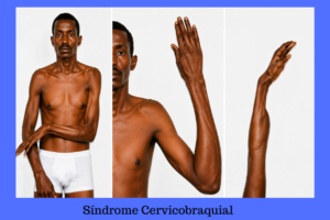 Síndrome Cervicobraquial